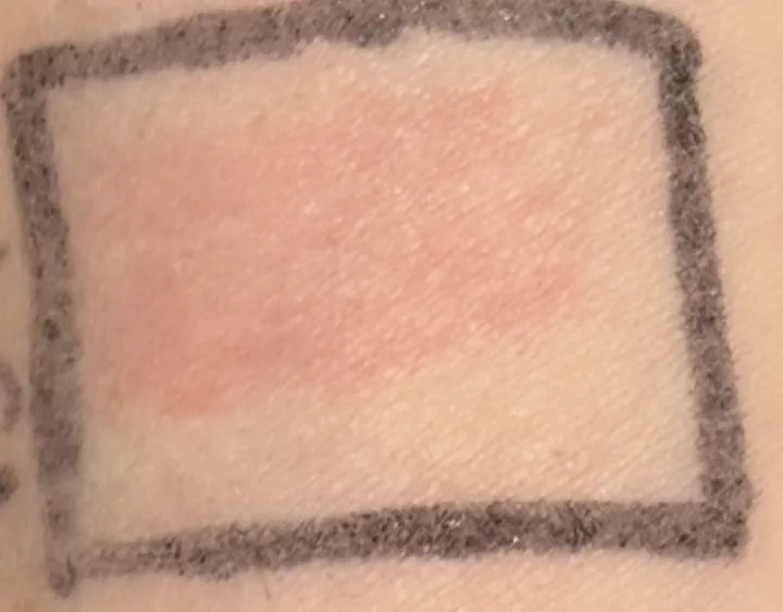 Arm without REYS — visible redness after UV exposure